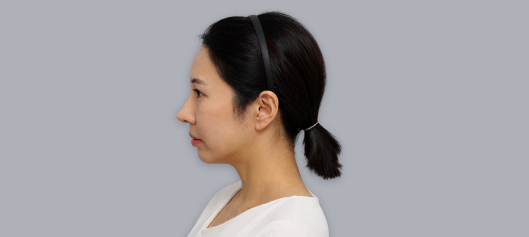 After revision rhinoplasty