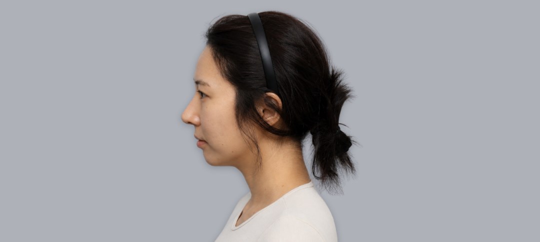 Before revision rhinoplasty